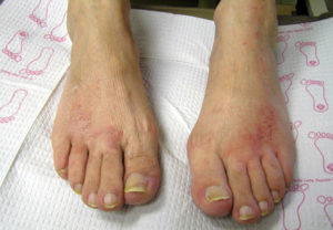 Foot infections