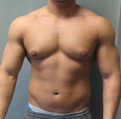 Gynecomastia Surgery